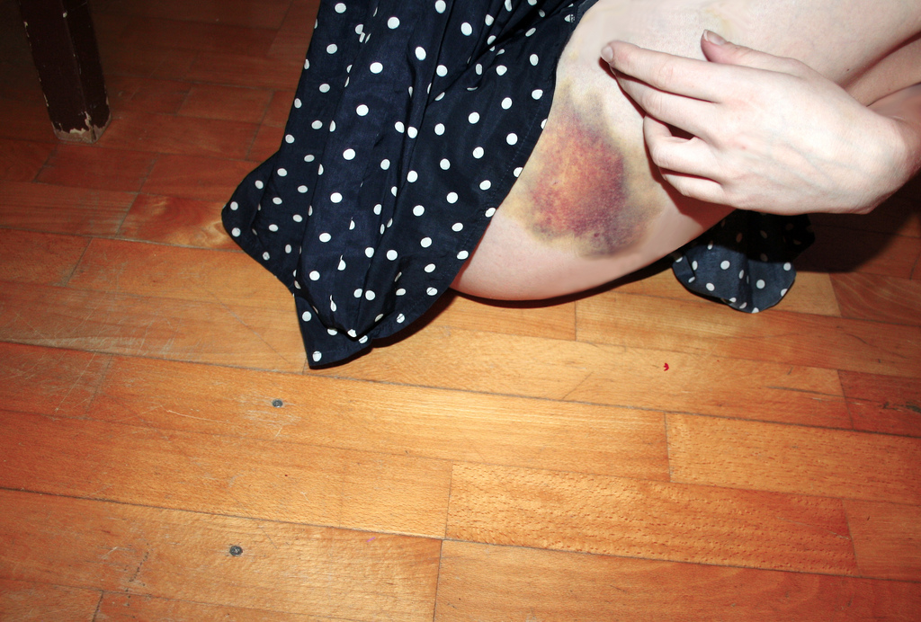 dřevo, vzor, krev, supernova, kloub, dívka, ruka, noha, nehet, prst, noha, design, patro, podlaha, dno, nehoda, střevíc, obuv, prst, stehno, podlaha, pohmoždit, modřiny, polka dot, dolní končetina, padací dveře